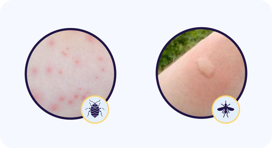 Comparatif entre piqures de moustiques et piqures de punaises de lit